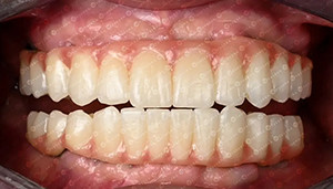 Laatste bedrijfscasus over Klantenzaak. 4D Zirconia blok.