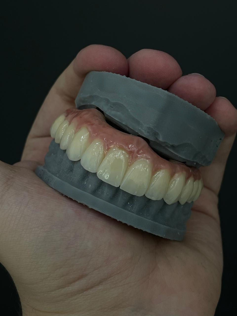 Laatste bedrijfscasus over Natuurlijke esthetiek bereiken met zirkoniumoxide: een succesvolle restauratie van een volledige boog uit Brazilië