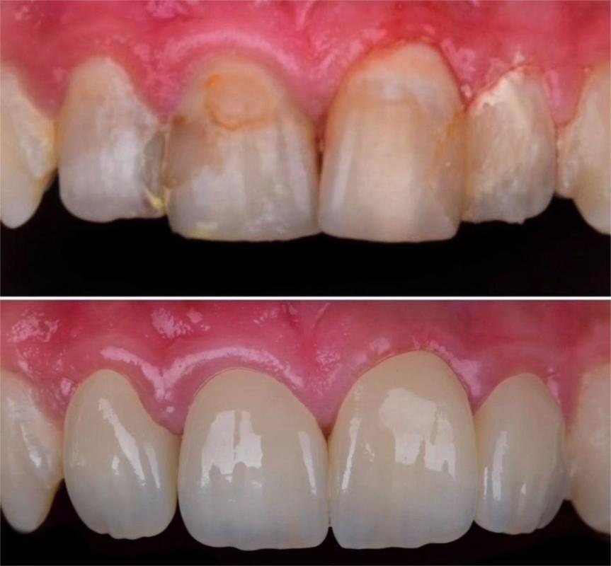 43%-57% Translucency 700-1200 MPa Bending Strength YUCERA Dental 89mm CAD/CAM 4D Pro Multilayer Zirconia Block